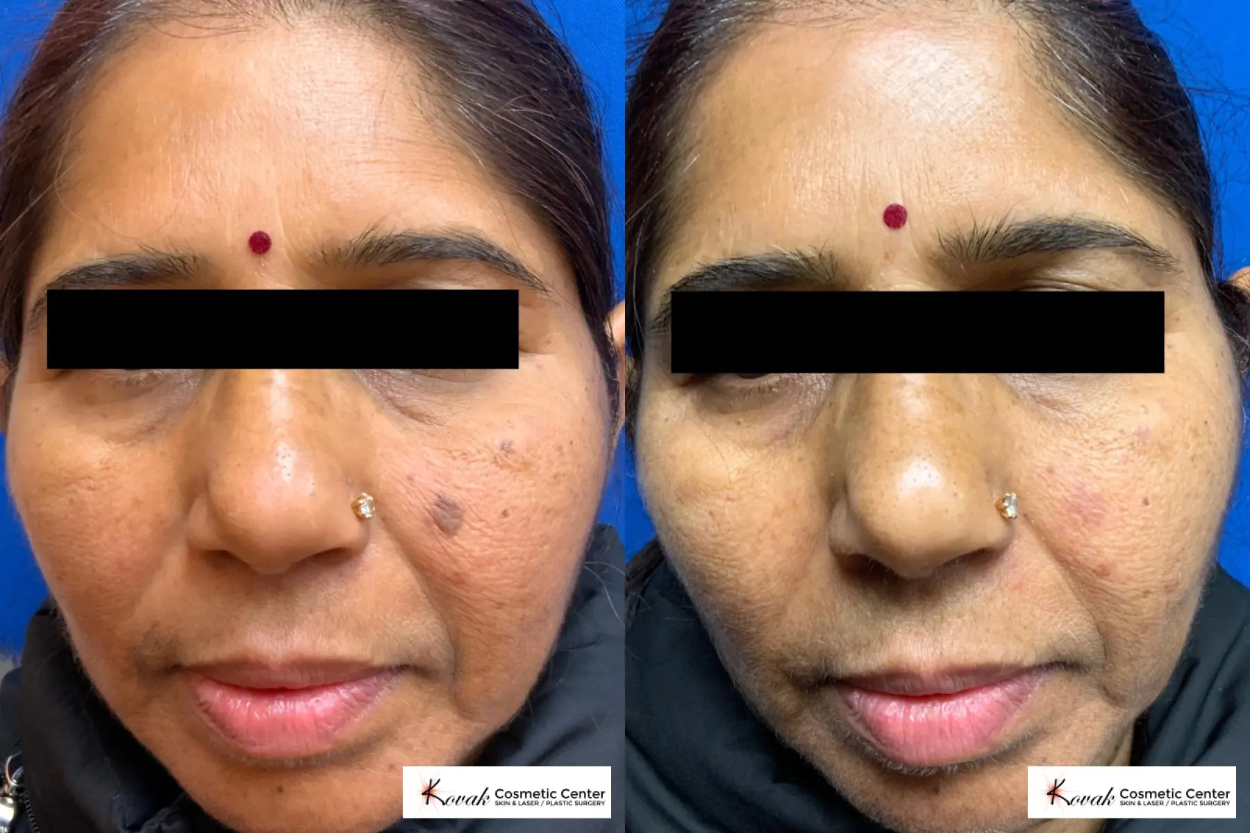 Seborrheic keratosis removed with a laser on a 60 yr old female - Before and After  