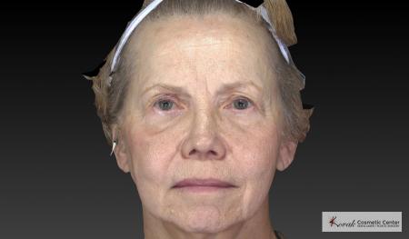 Sculptra®: Patient 4 - After 4