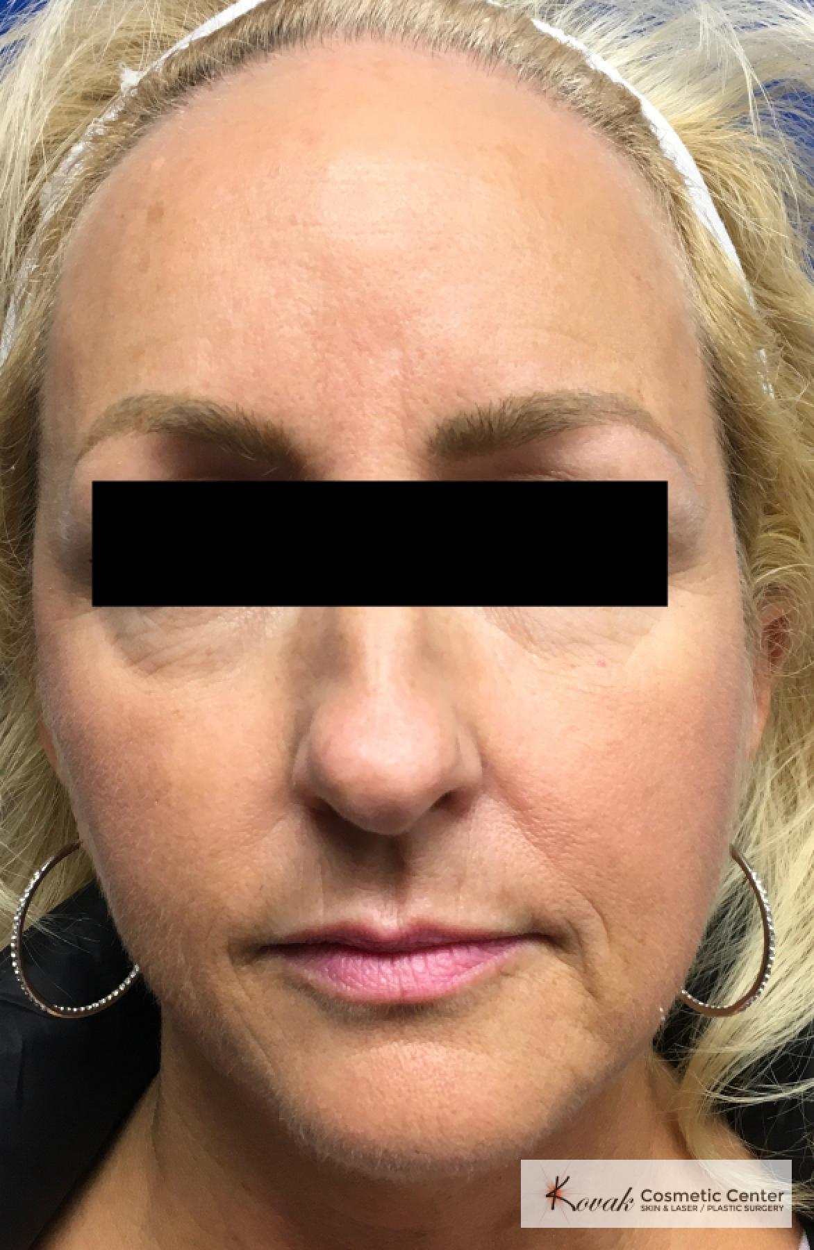 Sculptra®: Patient 6 - After  