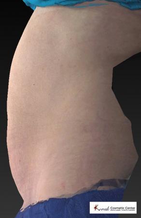 CoolSculpting Patient 101 - After 5