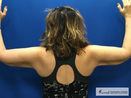 Laser Liposuction: Patient 6 - After 2