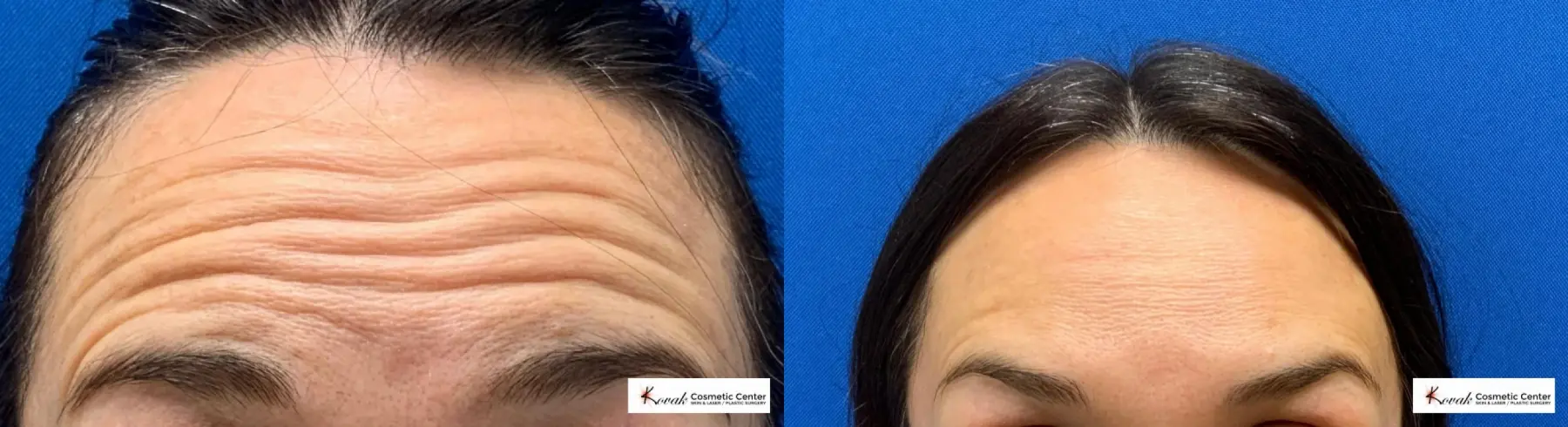 Neurotox Treatment using Jeuveau on a 40 year old female - Before and After  