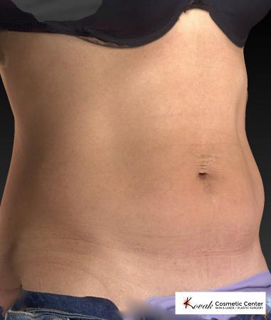 CoolSculpting®: Patient 6 - After Image 5