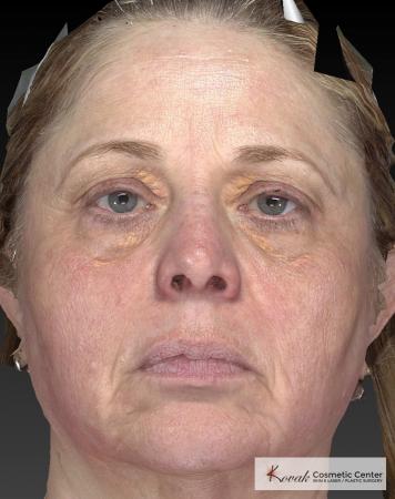 Tyte And Bryte – Face: Patient 3 - After Image 4