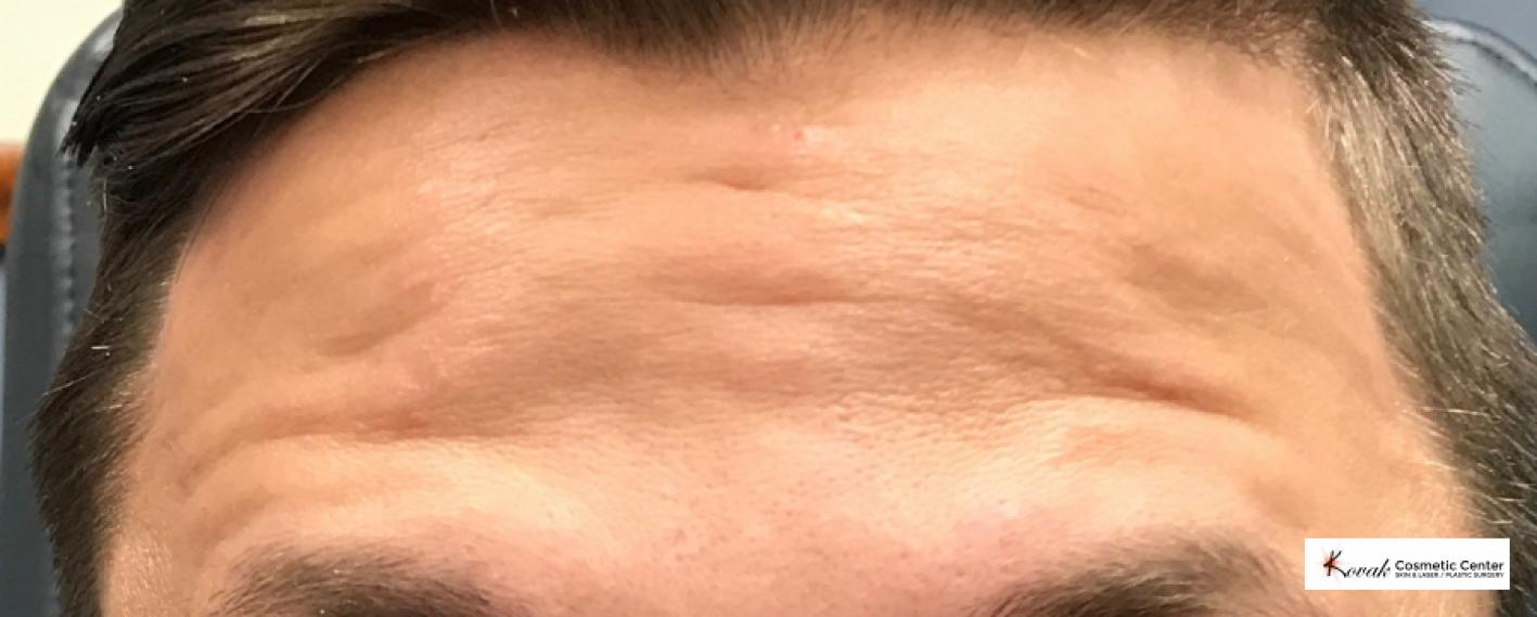 Botox for the forehead on a 30 year old male - After  
