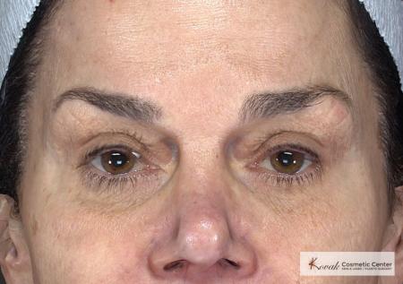 Laser Skin Resurfacing - Face: Patient 2 - Before Image 4