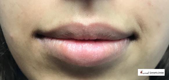 Restylane® Silk: Patient 6 - Before 