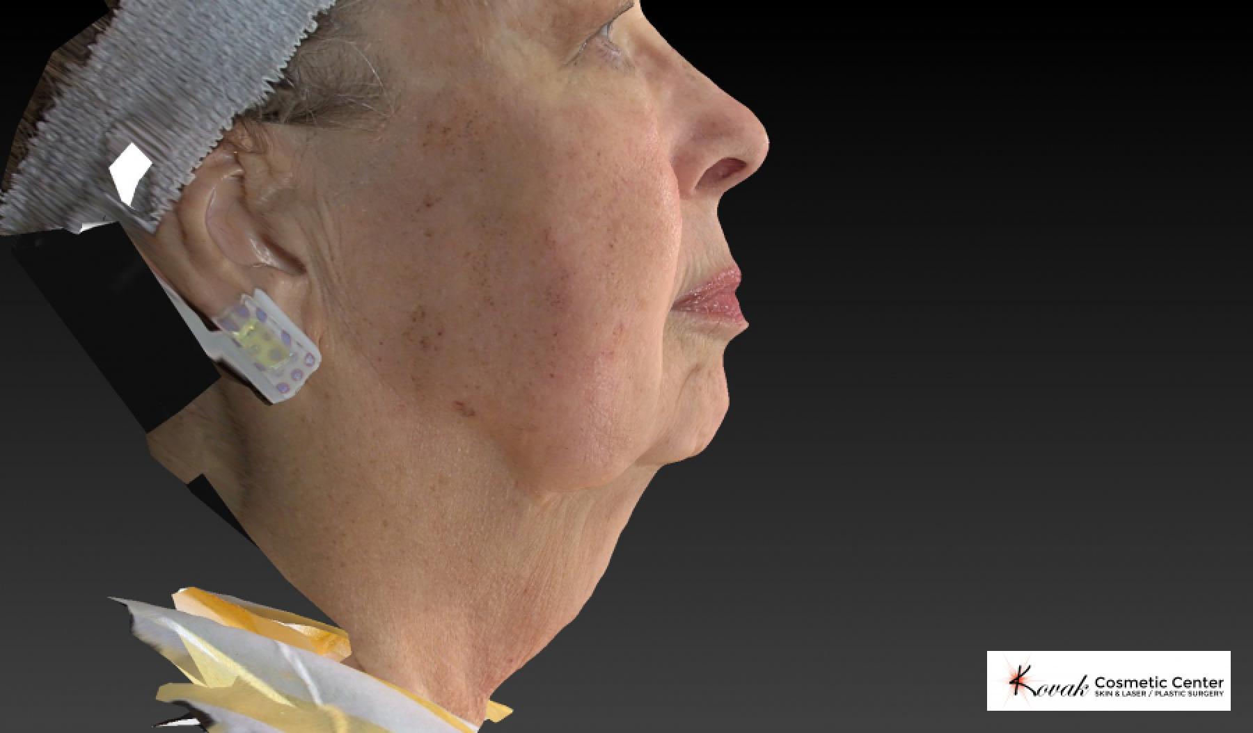 Kybella: Patient 3 - Before 