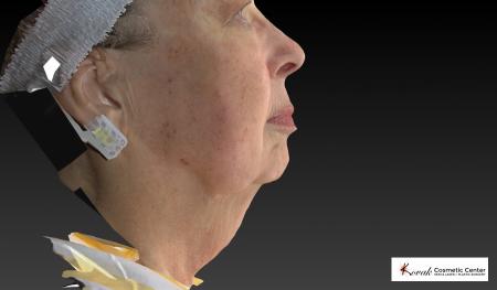 Kybella: Patient 3 - Before Image 1