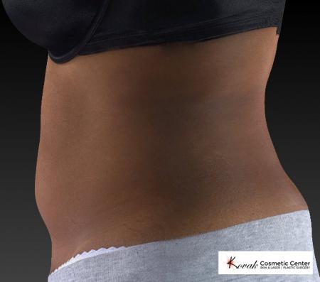 CoolSculpting®: Patient 15 - Before and After 4