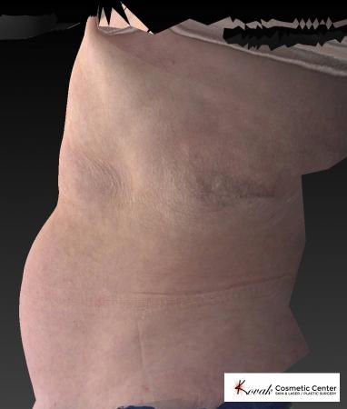 CoolSculpting®: Patient 13 - Before 2