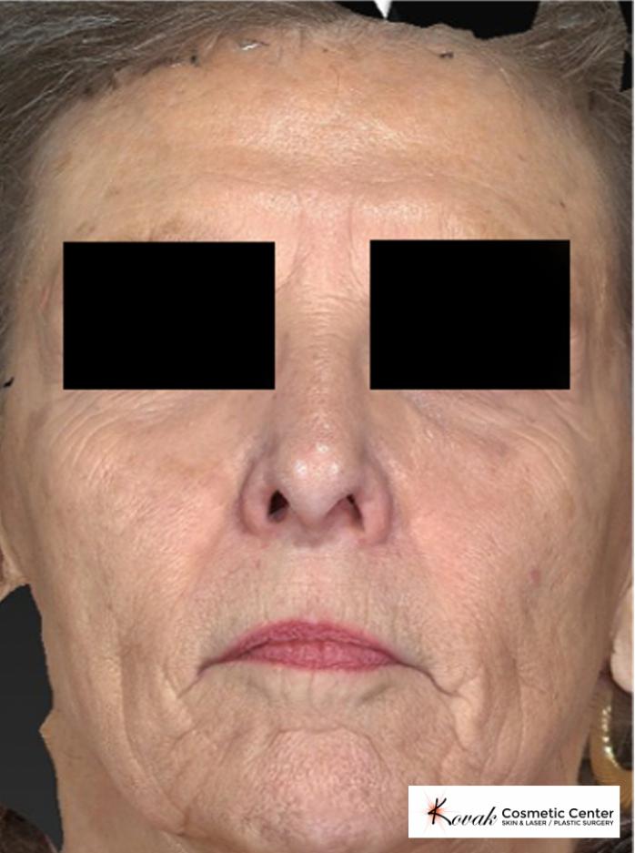 Sculptra®: Patient 2 - After  