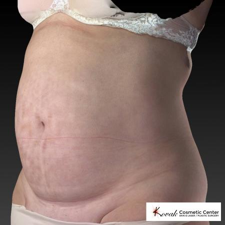 CoolSculpting®: Patient 11 - After 2