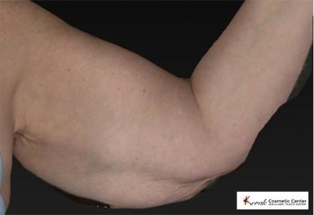 CoolSculpting®: Patient 14 - After 2