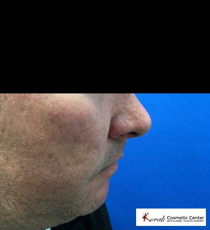 Juvéderm® XC: Patient 1 - Before 3
