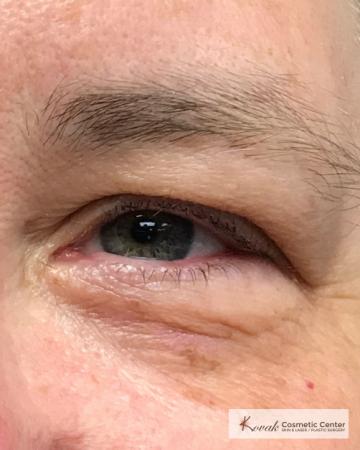 Lumps & Bumps: Patient 4 - After Image 1