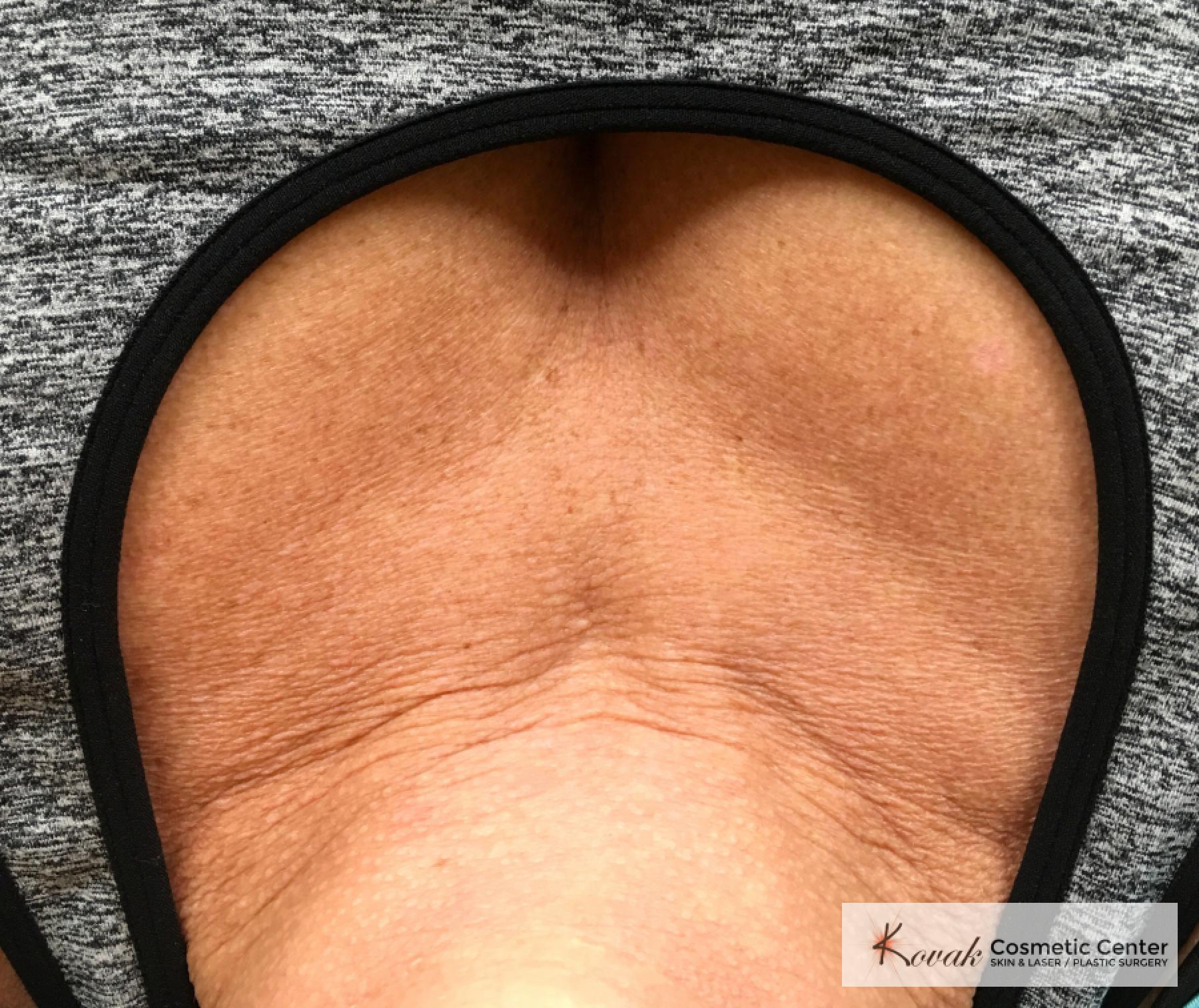 Restylane® Silk: Patient 10 - After  