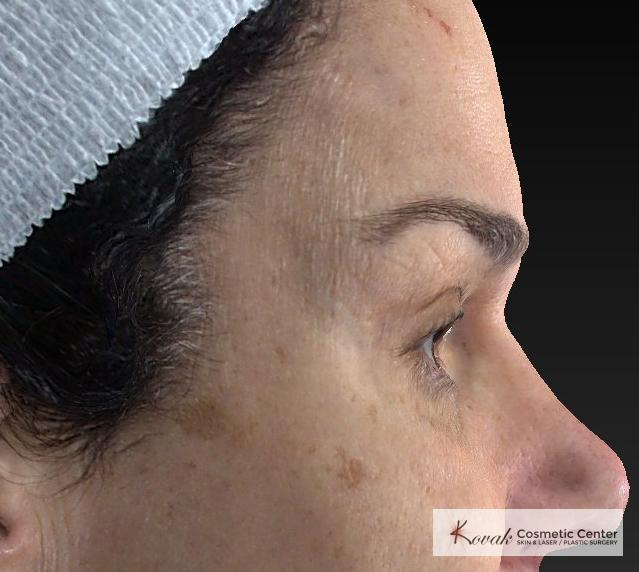 Laser Skin Resurfacing - Face: Patient 2 - Before 