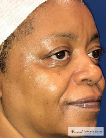 Lip Augmentation: Patient 1 - Before and After 3