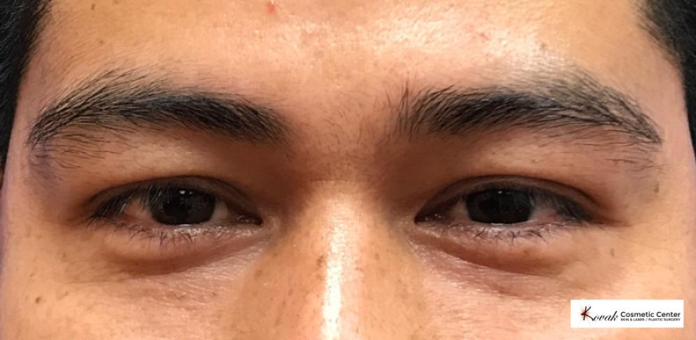 Injectables - Face: Patient 3 - After  