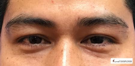 Injectables - Face: Patient 3 - After 1