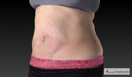 CoolSculpting®: Patient 18 - Before 3