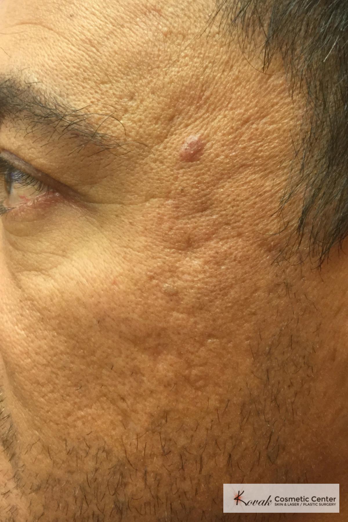 Acne Scars treated with Juvederm on 47 year old male - Before 