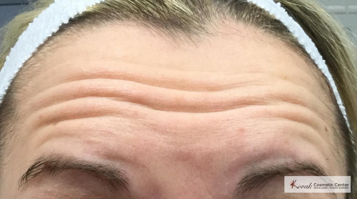 Botox for the brow/forehead on a 30 year old female - Before 
