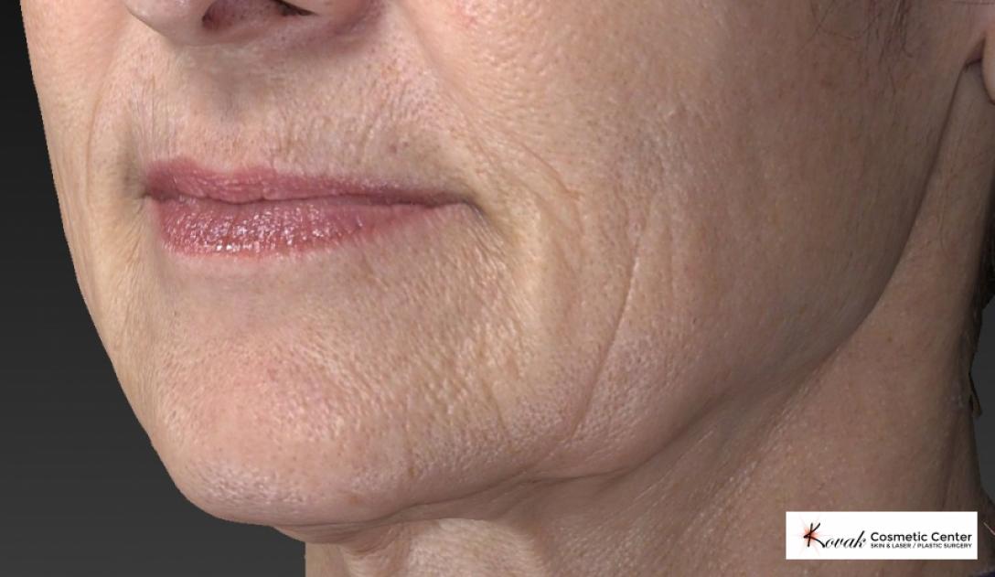 Restylane® Silk: Patient 2 - Before 4