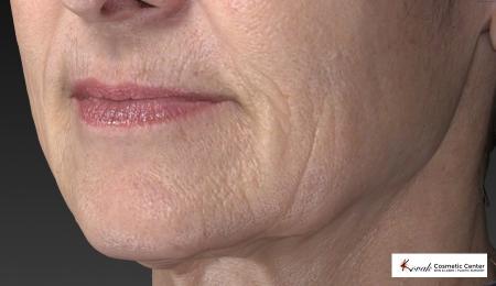 Restylane® Silk: Patient 2 - Before Image 4