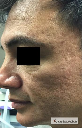 Juvéderm® XC: Patient 9 - After  