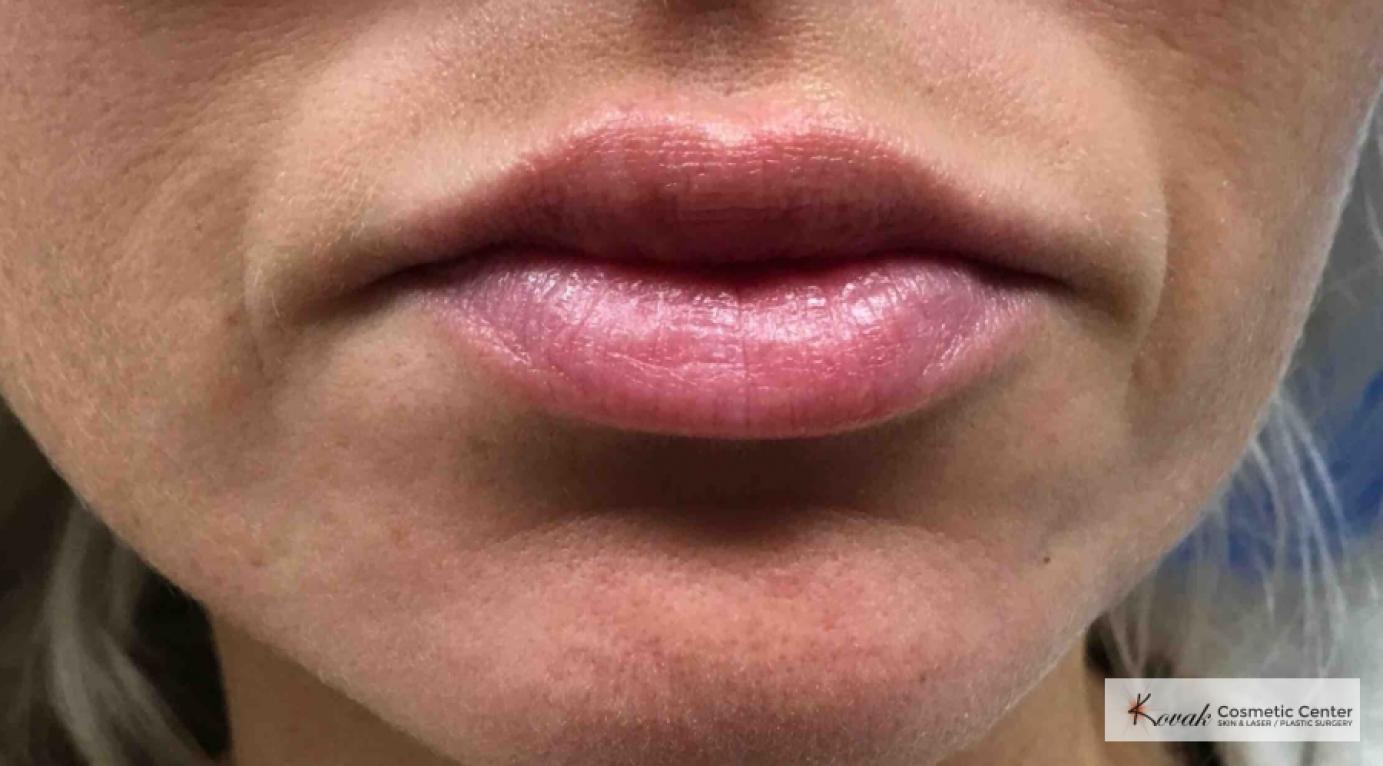 Injectables: Patient 5 - After  