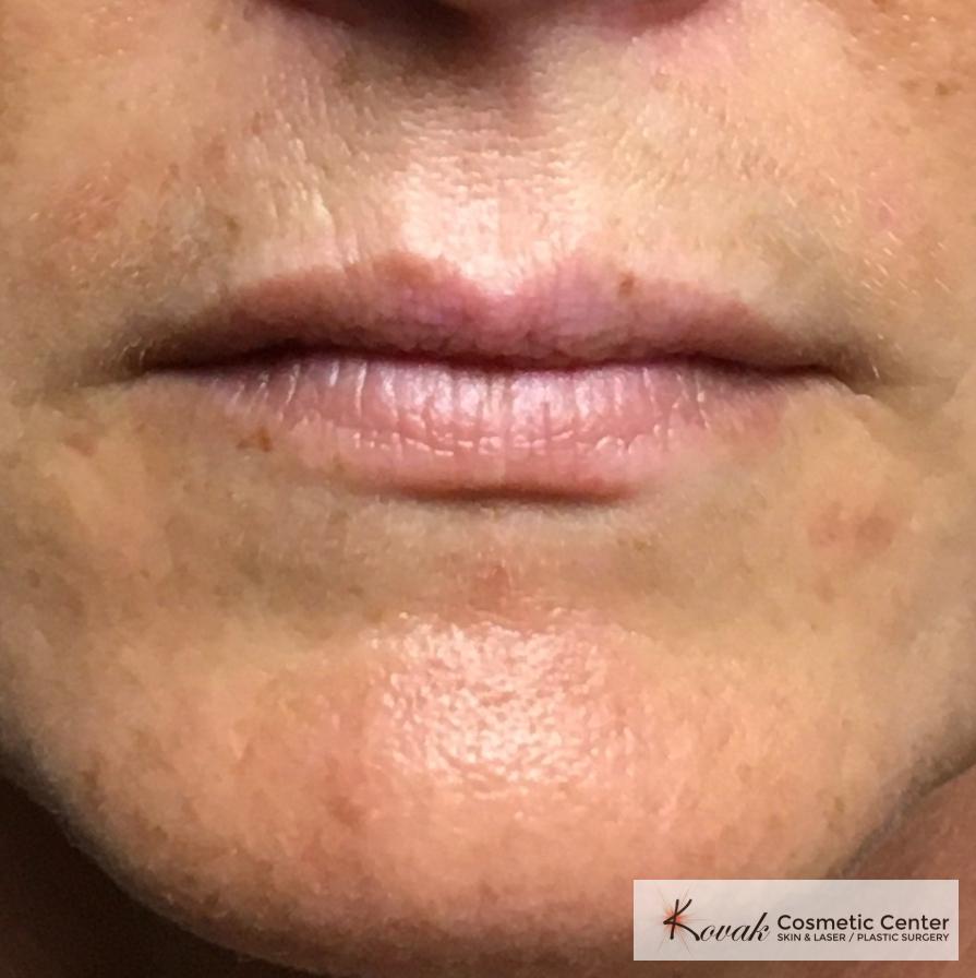 Fillers: Patient 1 - After  