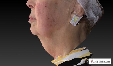 Kybella: Patient 3 - Before and After Image 5