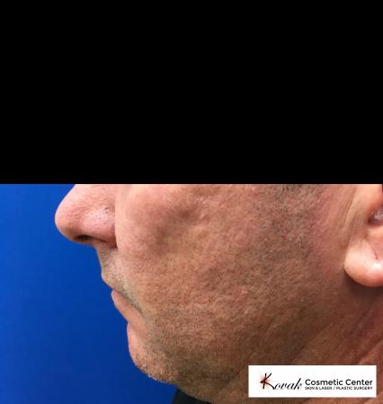 Juvéderm® XC: Patient 1 - Before and After 4