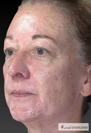 Tyte And Bryte – Face: Patient 6 - Before Image 2