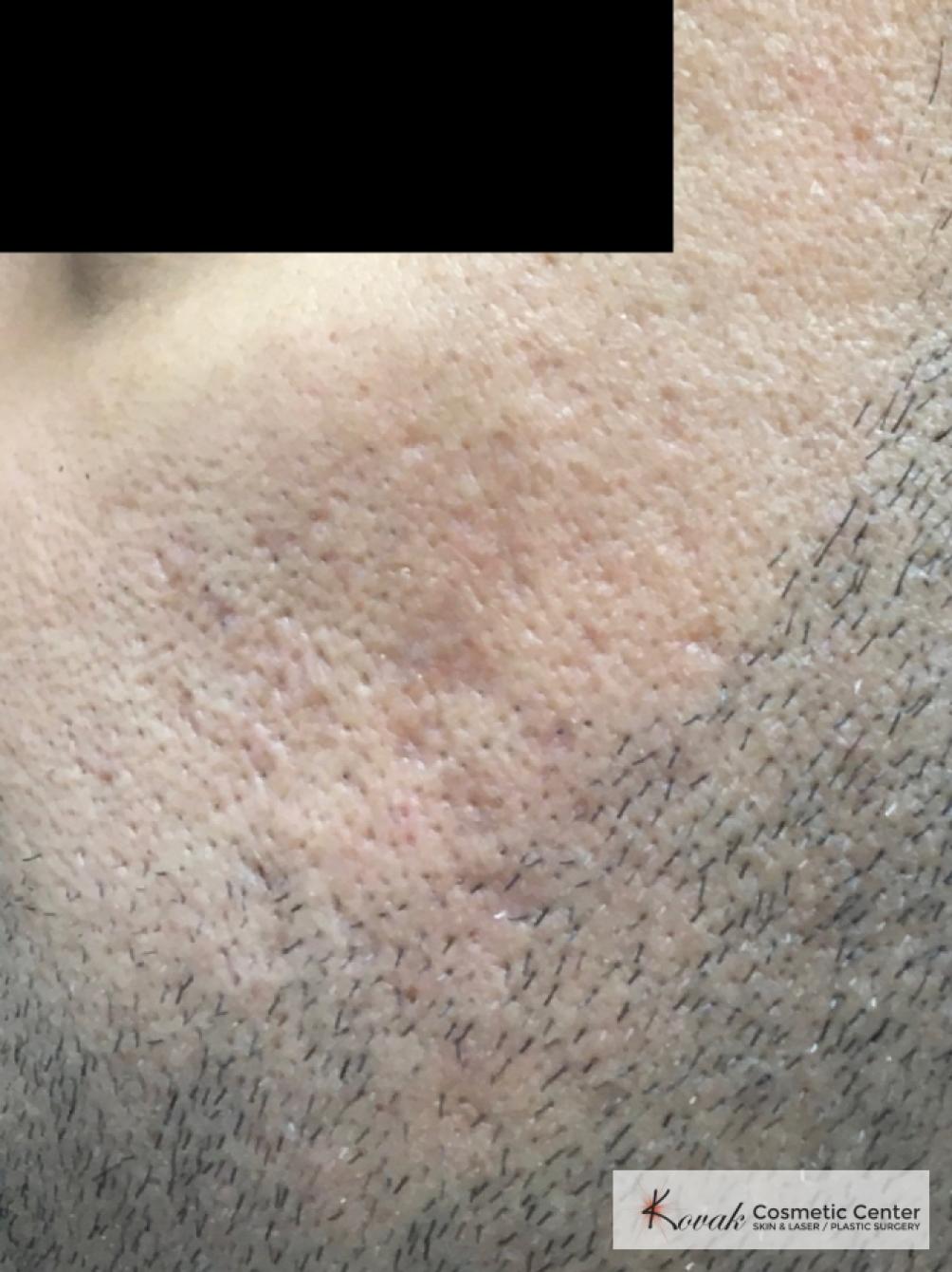 Acne Scars treated with Juvederm and Venus Viva on 35 year old male - After  