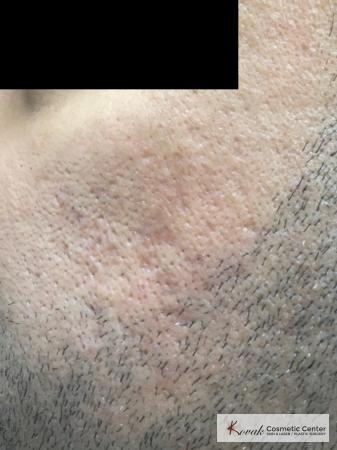 Acne Scars treated with Juvederm and Venus Viva on 35 year old male - After Image 1
