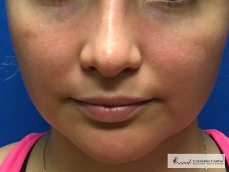 Laser Liposuction of the jawline on a 25 year old female patient - Before 1