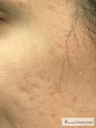 Acne Scars treated with Venus Viva on 28 year old woman - After Image 2