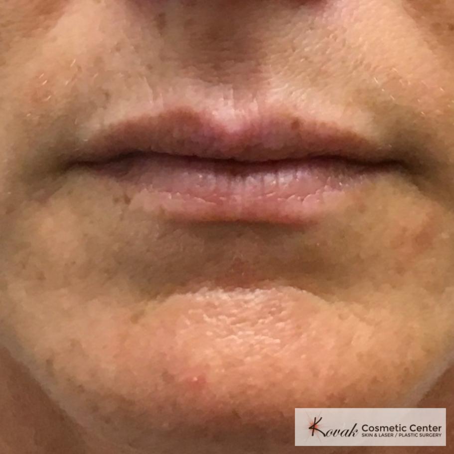 Fillers: Patient 1 - Before 