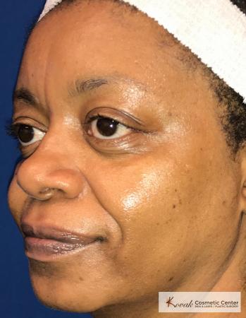 Lip Augmentation: Patient 1 - Before 2