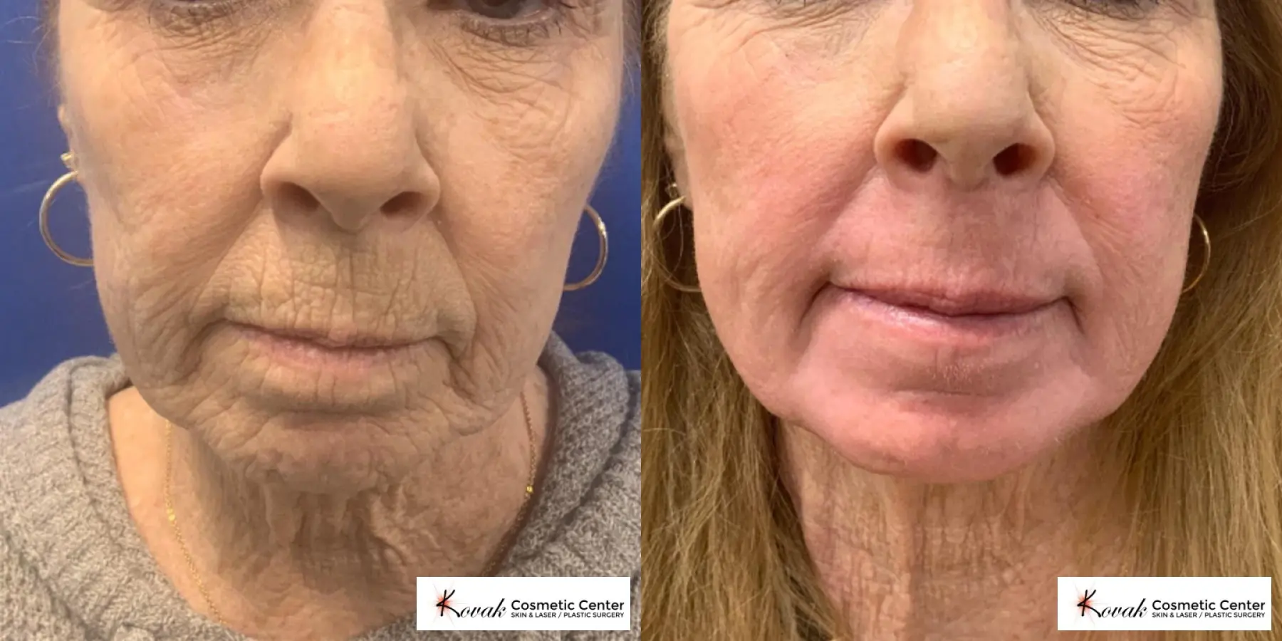 Resurfacing: Patient 2 - Before and After 1