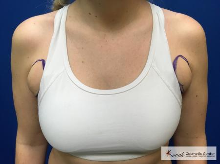 Laser Liposuction: Patient 4 - Before and After 3