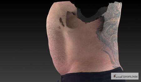 CoolSculpting®: Patient 20 - Before and After 5