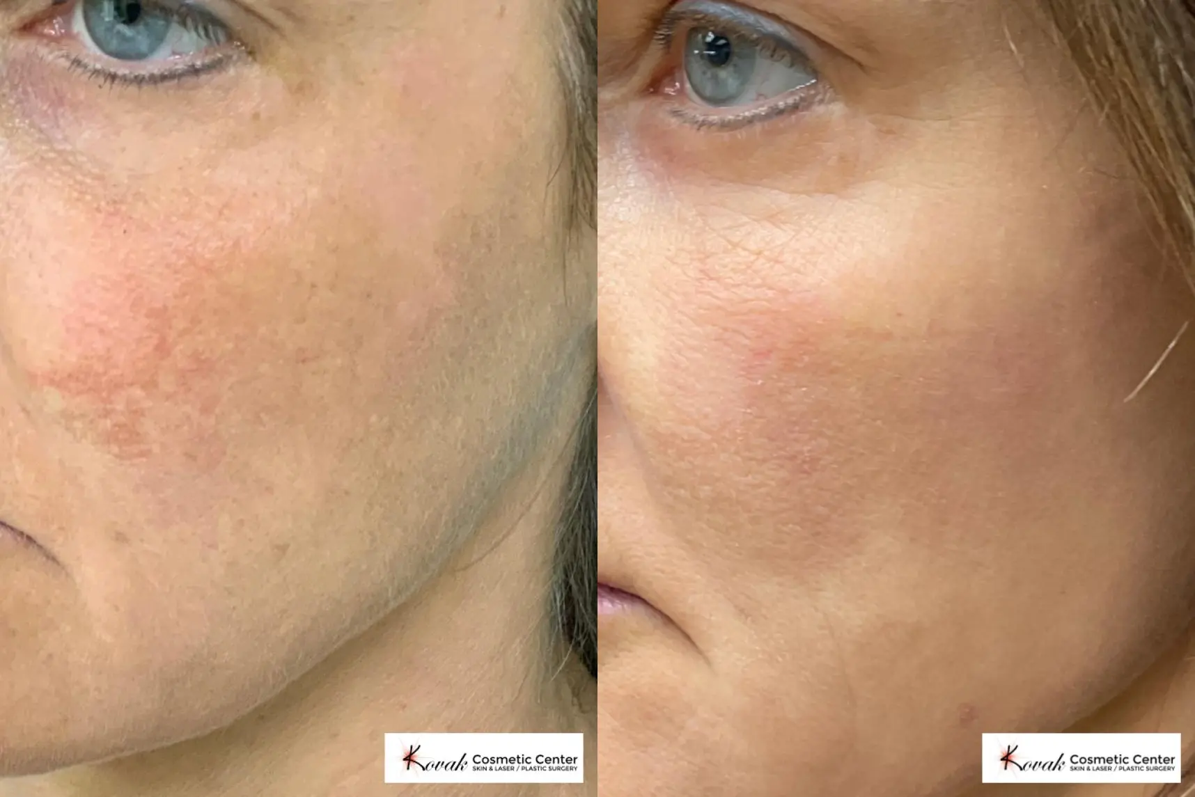 Rosacea treatment on a 53 year old female - Before and After  