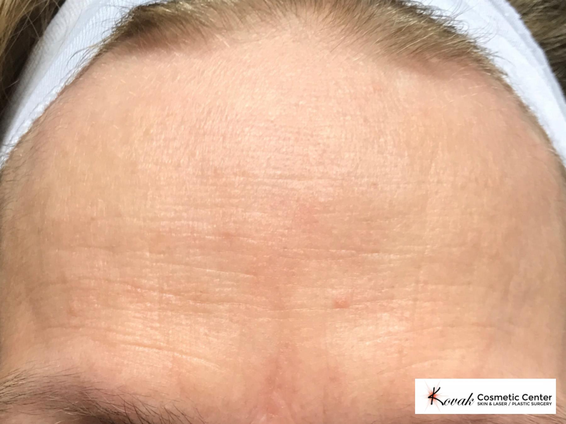 Forehead lines treated with Restylane Silk on 60 year old female - After 1