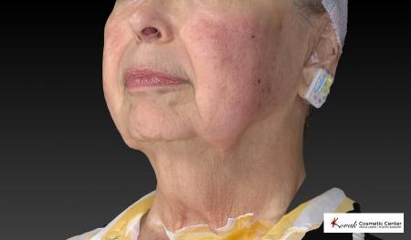 Kybella: Patient 3 - Before Image 4