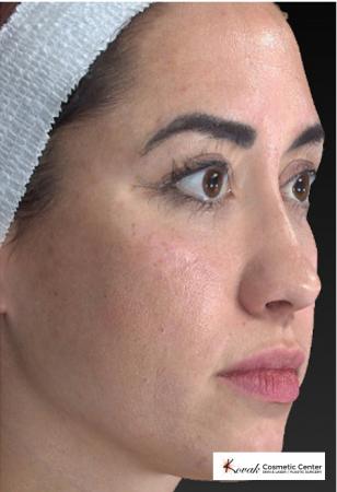 Sculptra®: Patient 3 - Before 2
