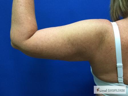 Laser Liposuction of the arms on a 42 year old woman - After 2